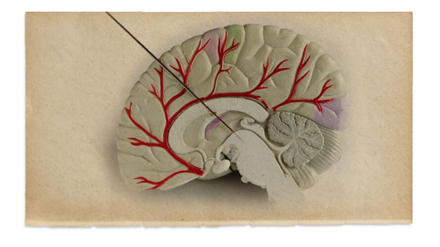 التحفيز العميق للدماغ