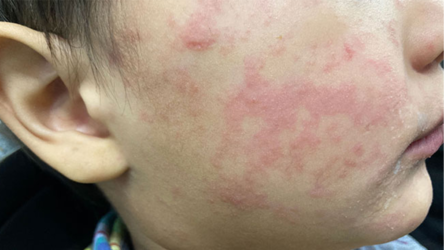 ماذا يقول العلم عن فاعلية علاج مرض الحصبة بفيتامين أ؟