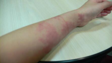 ماذا تفعل عندما يقع ماء ساخن على جلد طفلك؟