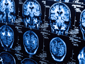 دراسة: علامات تقدم السن تظهر على أدمغة المراهقين بسبب الجائحة