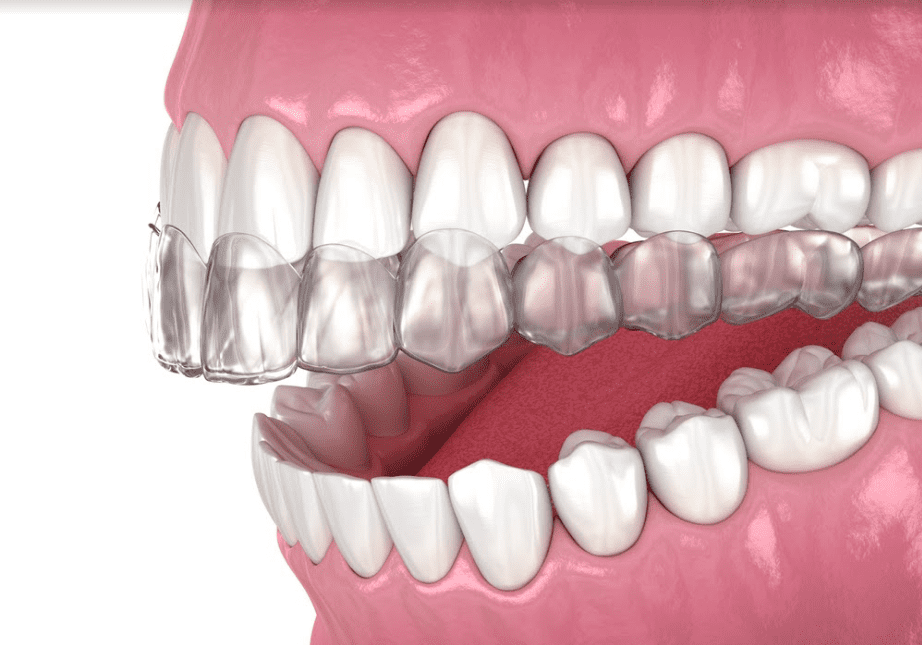 تقويم الأسنان الشفاف