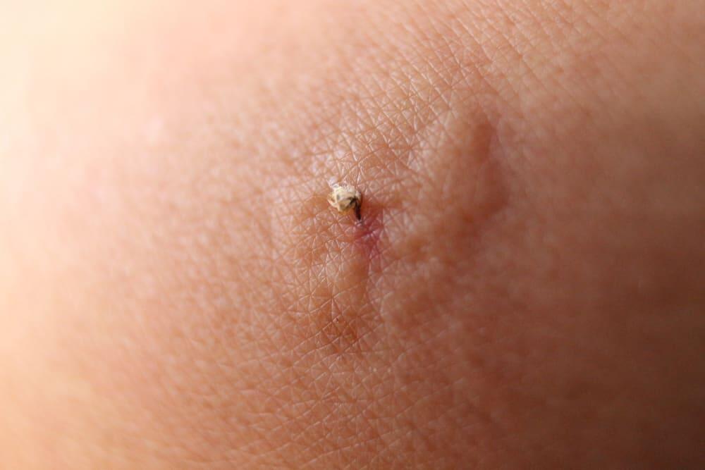 شكل لسعة النحلة