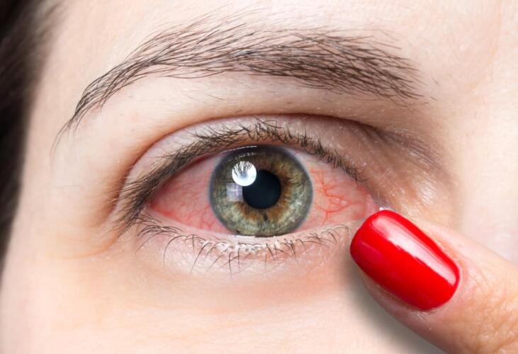 ما أسباب احمرار العينين وكيف يُعالَج؟