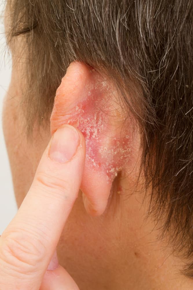 الصدفية المعكوسة