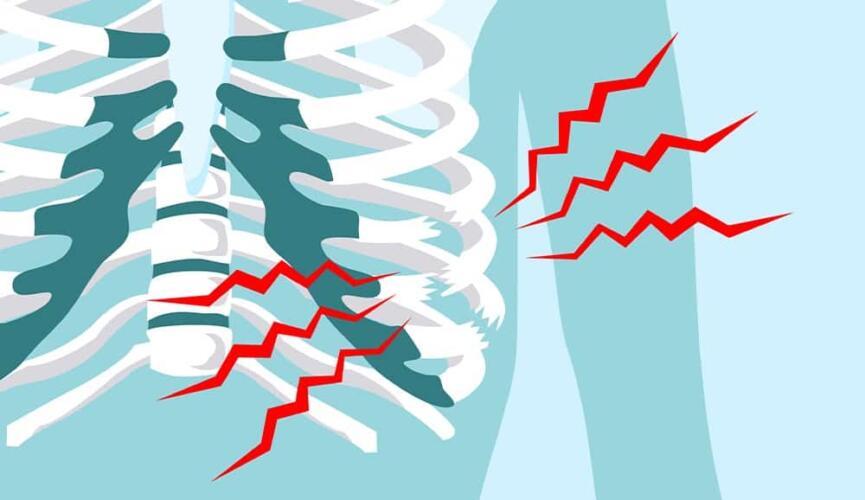 دليلك لفهم كسور الأضلاع وأسبابها وعلاجها