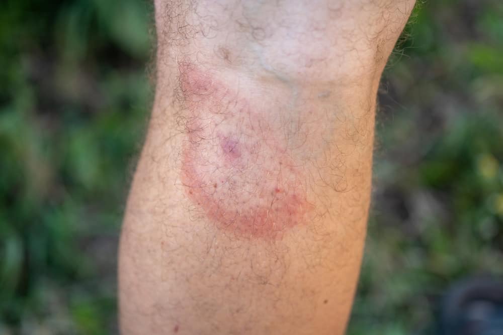 طفح جلدي يميّز مرض لايم