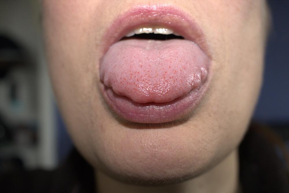 التهاب الحليمات اللسانية