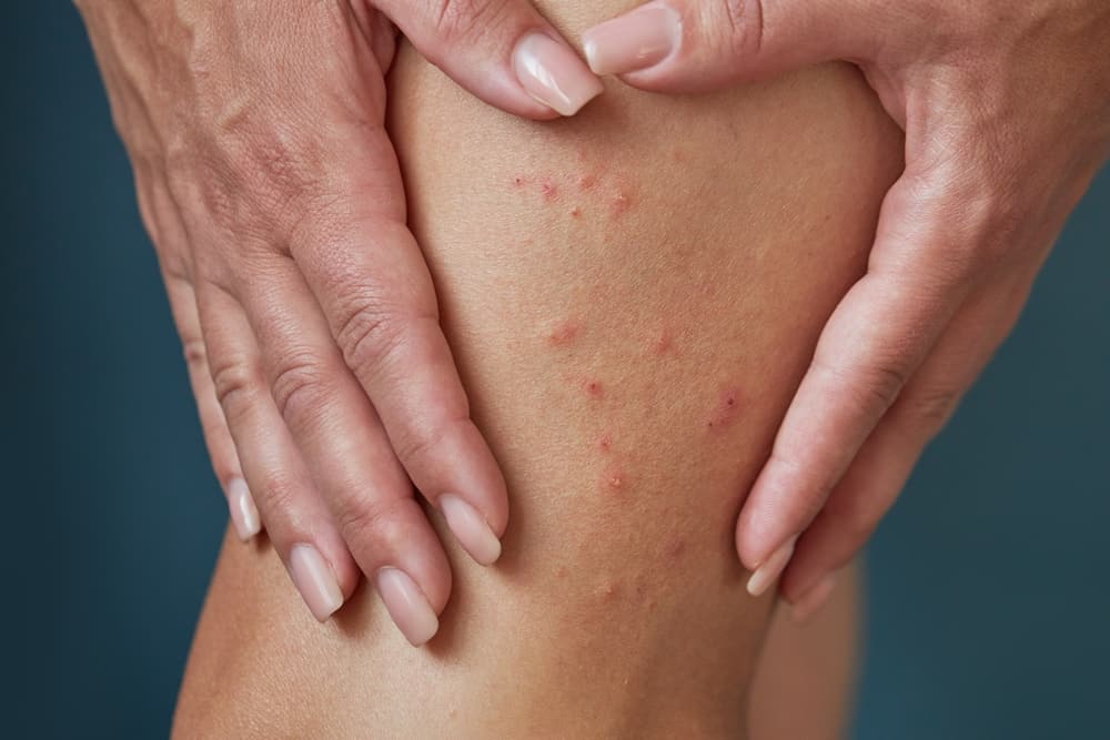 شكل لدغات العث