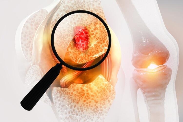 ما هو سرطان العظام؟ وما الأعراض التي تكشف الإصابة به؟