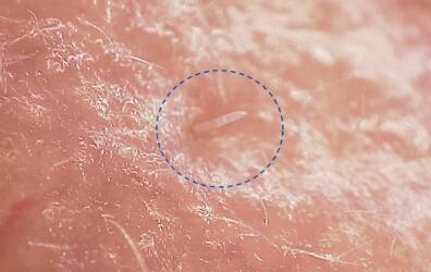 عث الوجه سيصبح أكثر «التصاقاً» بنا