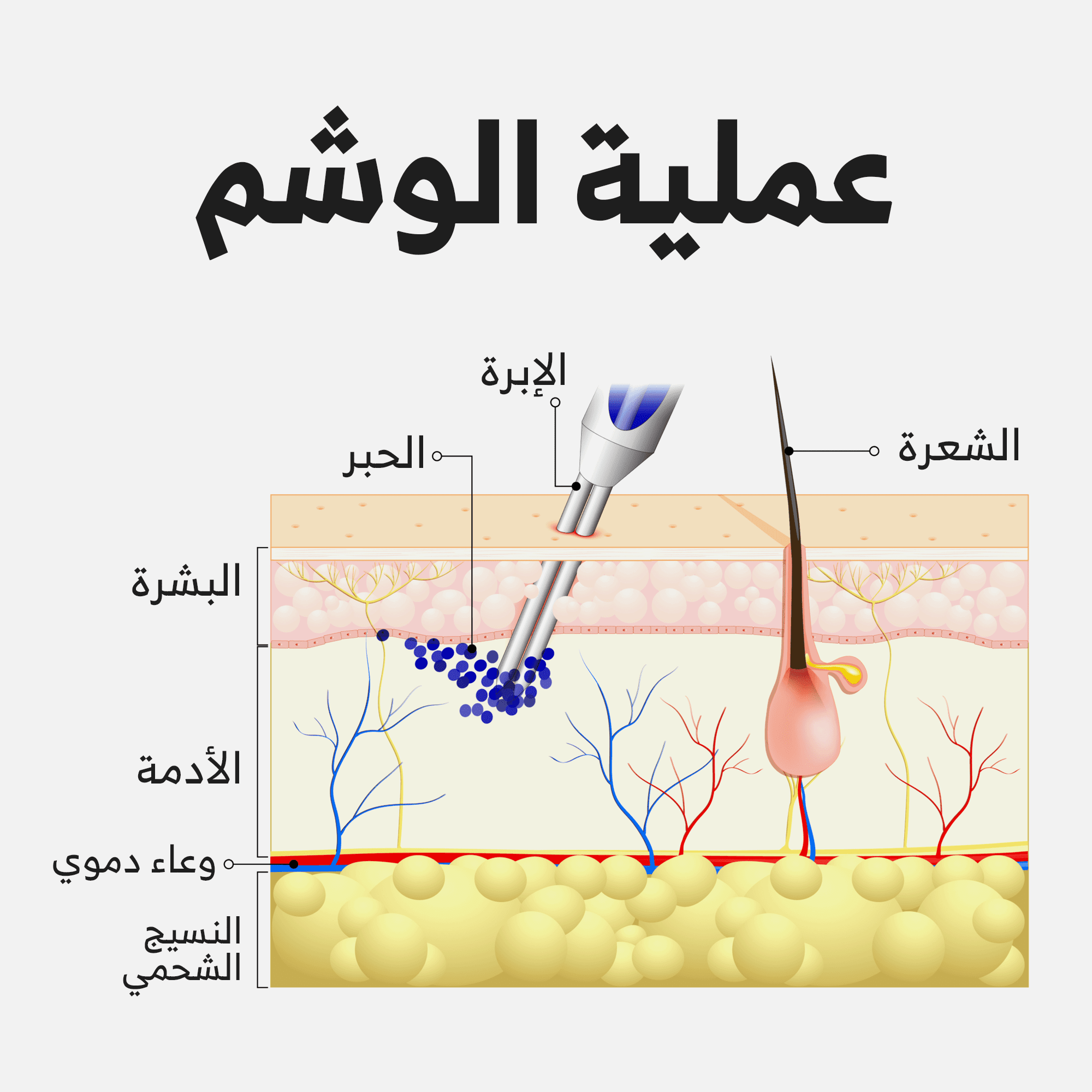 عملية إزالة الوشم