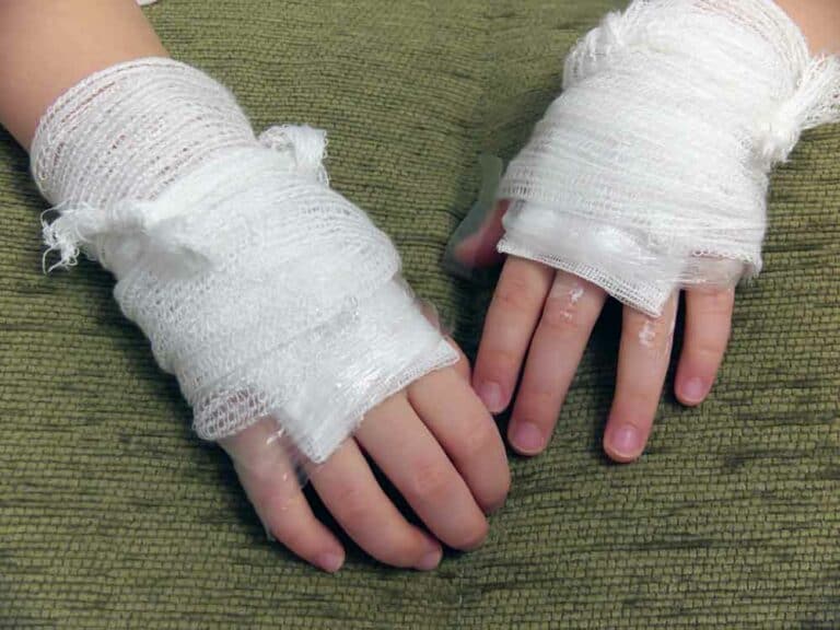 إسعافات الحروق الأولية بأنواعها