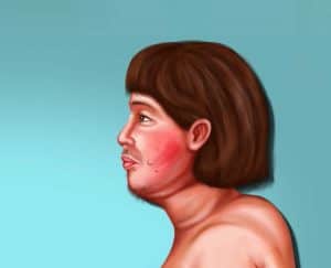 متلازمة كوشينج, الوجه القمري, صحة, أمراض