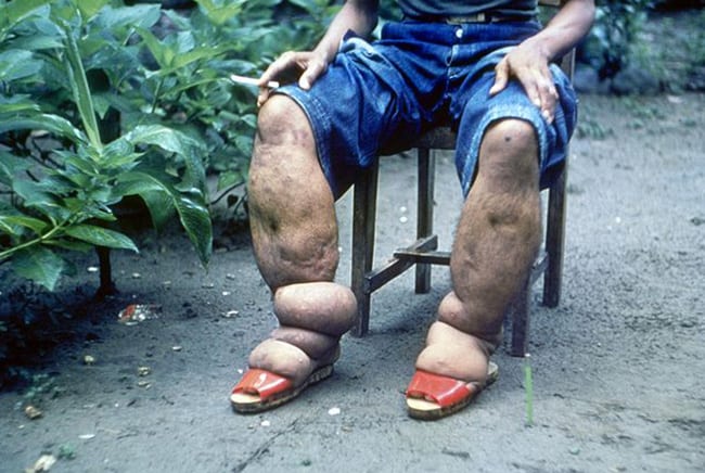 حصاد 2019, داء الفيل, مرض الفيل, أمراض, صحة