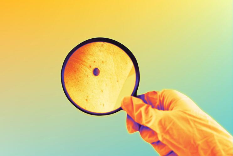 كيف نُميّز سرطان الجلد عن الشامة السليمة؟