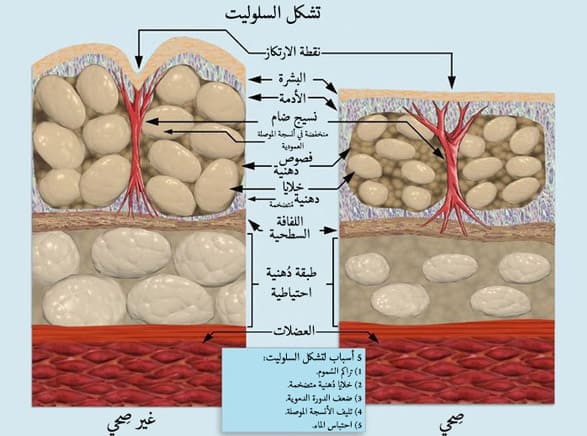 السيلوليت, صحة, دهون, تمارين التخلص من السيلوليت