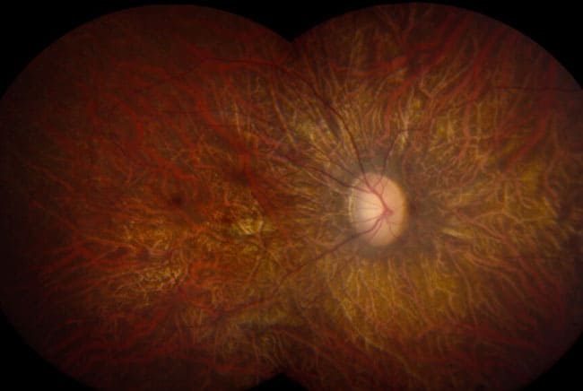 شكبية العين, العمى, الإبصار, النظر, تقنية, علوم